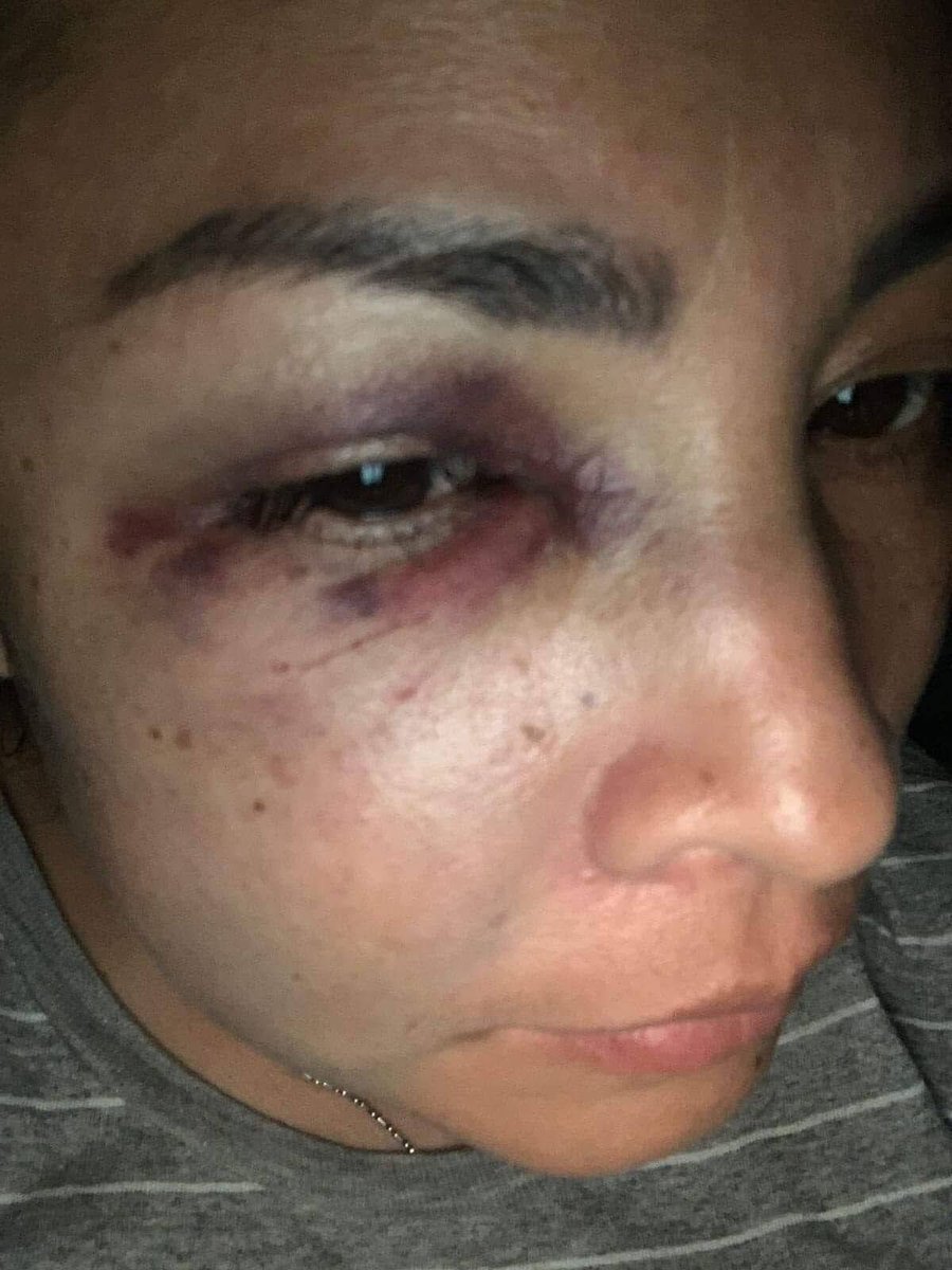 amarilloalarcon's tweet photo. En este #8M cabe recordar que una mujer fue agredida a PUÑETAZOS x los encargados del #BarBarroco en la #FeriaDelCaballo de #Texcoxo
Así ña dejaron y la @FiscaliaEdomex #FiscaliaDeTexcoco ha dejado el caso de lado y en la impunidad
Ojo fiscal José Luis Cervantes 👇🏼👇🏼 https://t.co/hnBqvcLAjM