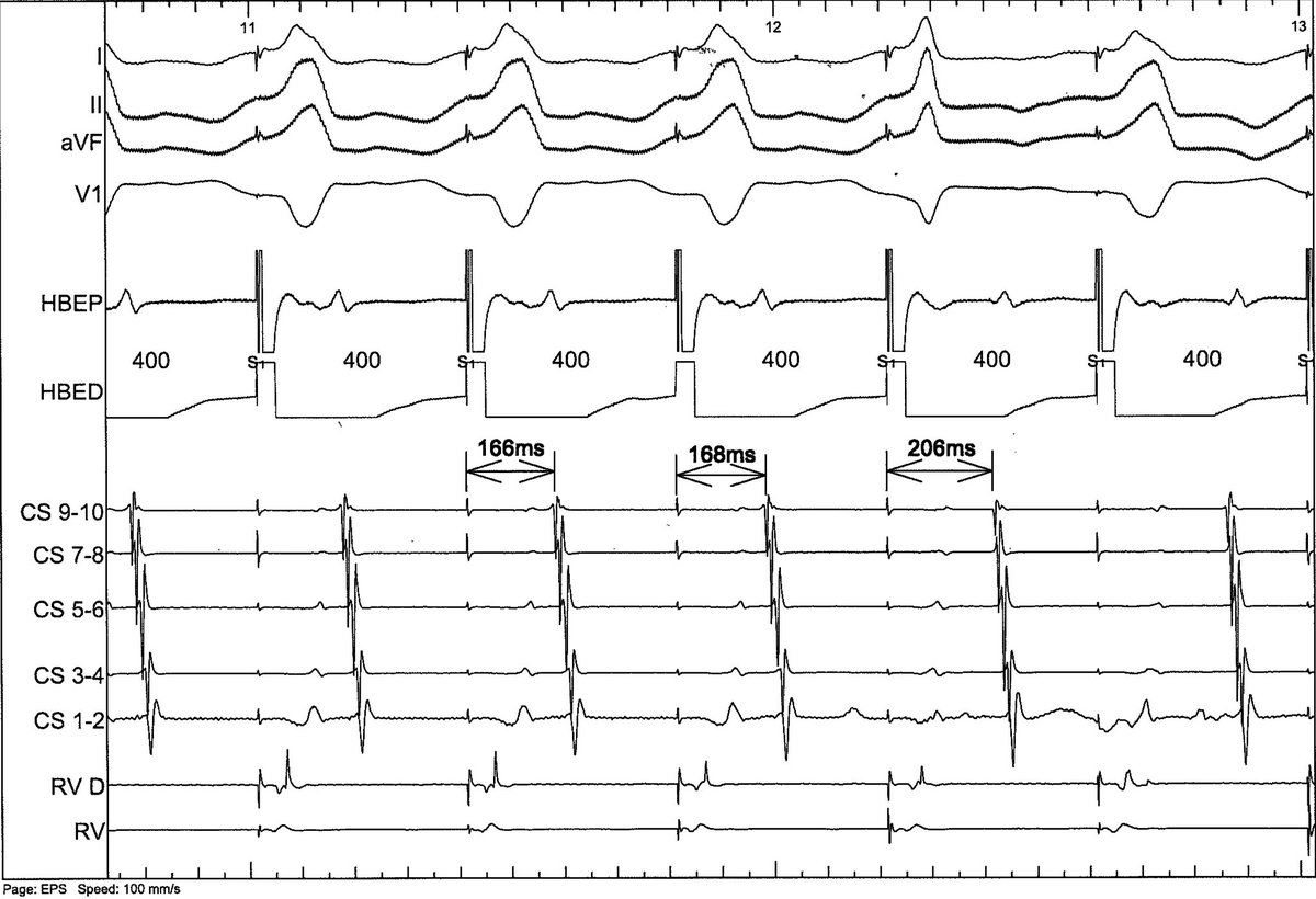Interesting response to parahisian pacing.  How can that be?