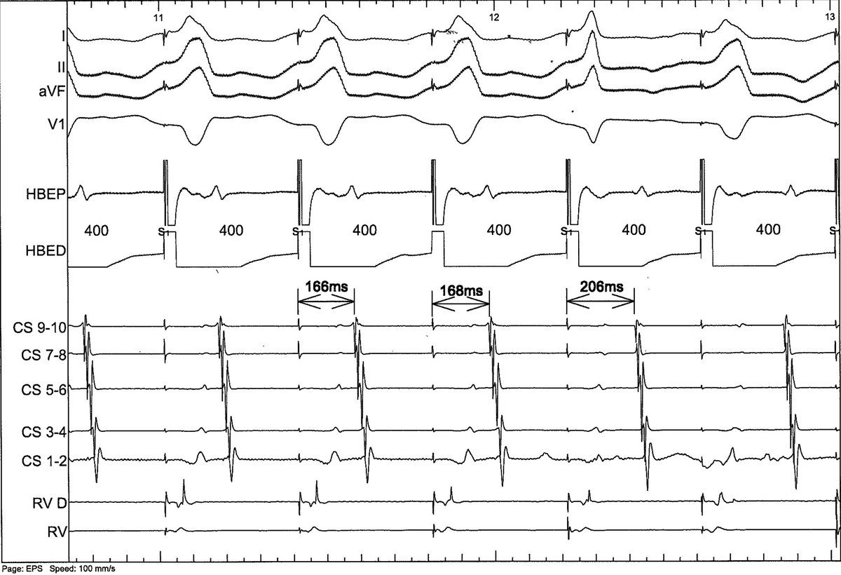 Interesting response to parahisian pacing. How can that be?