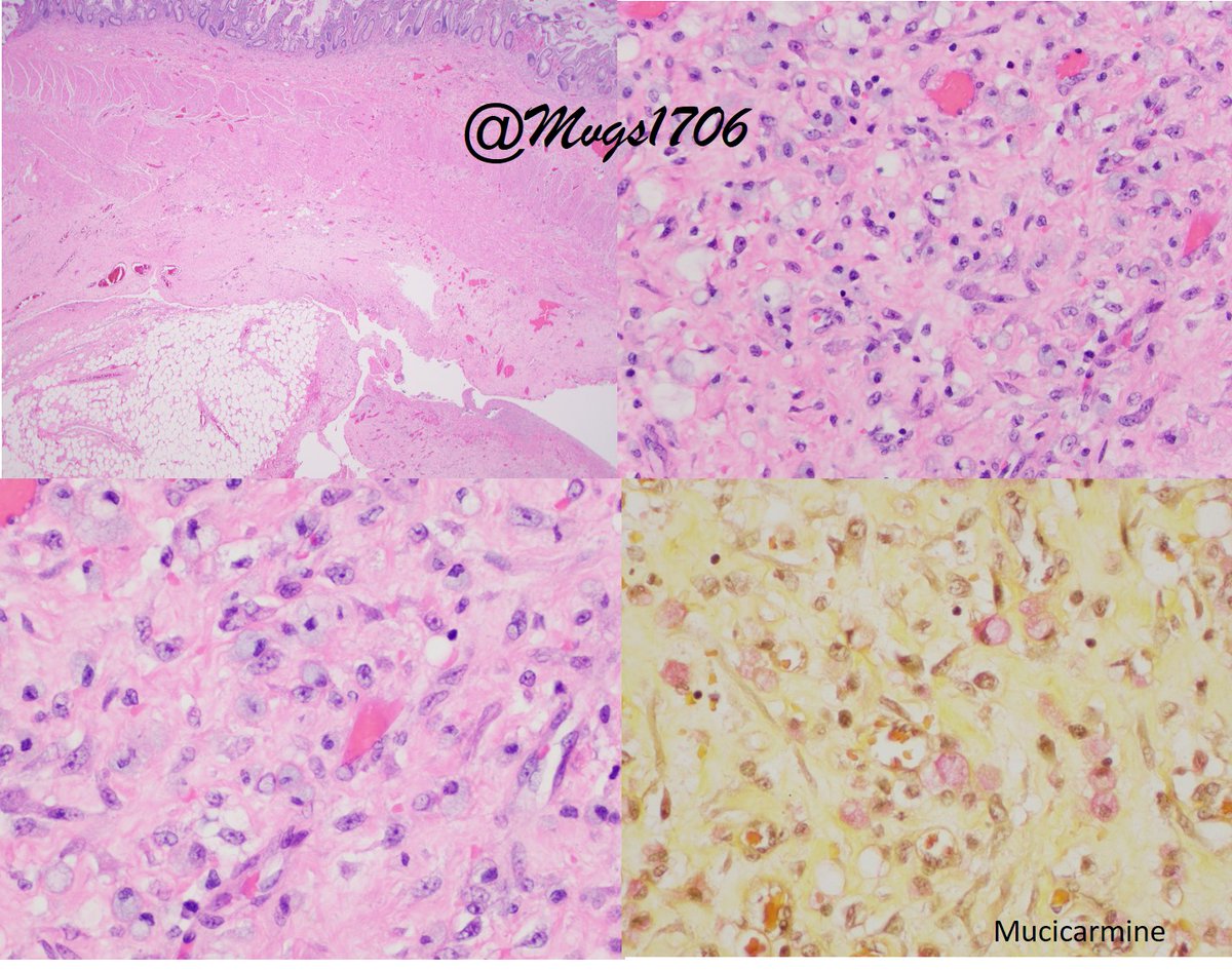 Mvgs1706's tweet photo. Pitfall Alert!!!
Seen at the site of bowel perforation..
What do you think #pathtwitter #GIpath ?
Signet ring cells?? Pseudo signet ring cells??
Answer in the next tweet... https://t.co/lpwU56Mxci