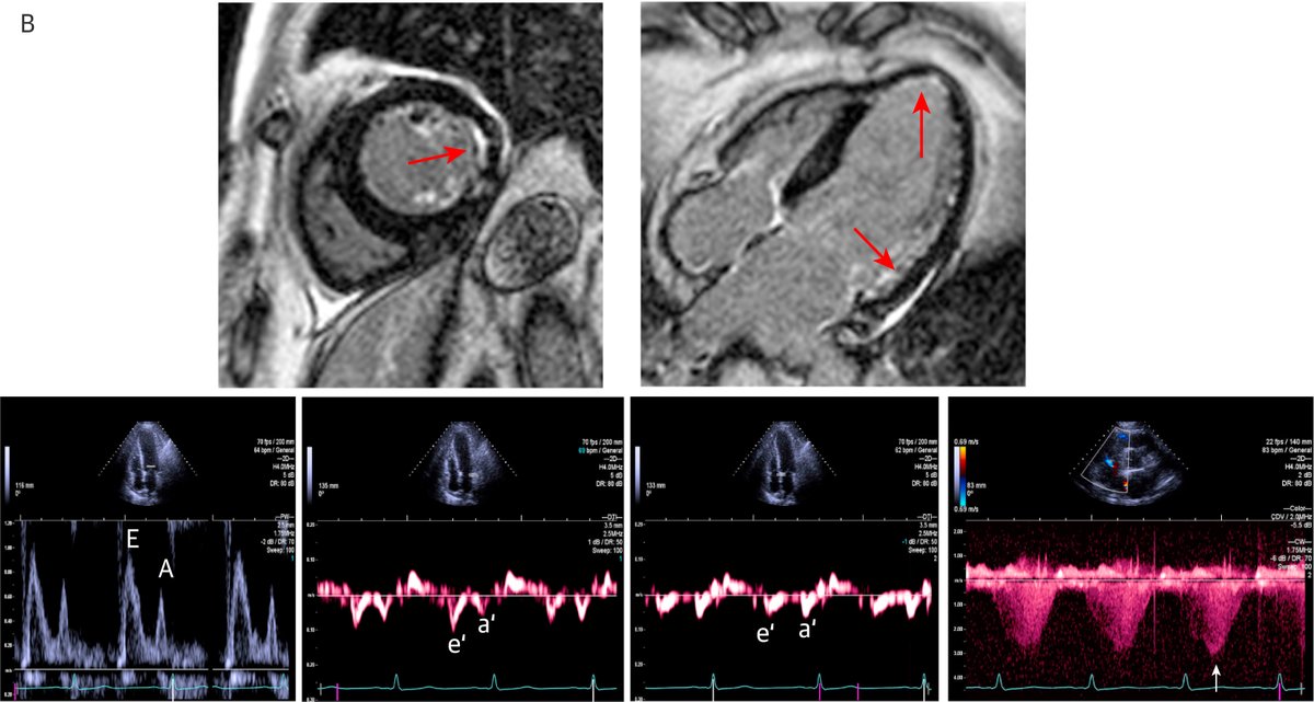 Dipan J. Shah, MD (@dipanjshah) on Twitter photo <a href="/JACCJournals/">JACC Journals</a> <a href="/HMethodistCV/">Houston Methodist CV</a> <a href="/SNagueh/">Sherif F Nagueh</a> <a href="/tachycore/">Eric Y. Yang</a> <a href="/MaanMalahfji/">Maan Malahfji</a> <a href="/HeartToProve/">Carlos El-Tallawi, MD “HeartToProve”</a> <a href="/ChamsiPash/">Mohammed Chamsi Pasha, FACC, FASE</a> Higher grades of diastolic dysfunction are seen in patients with replacement fibrosis and increased ECV. Fibrosis burden as determined with the use of CMR provides incremental prognostic information to echocardiographic evaluation of LV diastolic function. <a href="/JACCJournals/">JACC Journals</a> <a href="/HMethodistCV/">Houston Methodist CV</a> <a href="/SNagueh/">Sherif F Nagueh</a> <a href="/tachycore/">Eric Y. Yang</a> <a href="/MaanMalahfji/">Maan Malahfji</a> <a href="/HeartToProve/">Carlos El-Tallawi, MD “HeartToProve”</a> <a href="/ChamsiPash/">Mohammed Chamsi Pasha, FACC, FASE</a> Higher grades of diastolic dysfunction are seen in patients with replacement fibrosis and increased ECV. Fibrosis burden as determined with the use of CMR provides incremental prognostic information to echocardiographic evaluation of LV diastolic function.