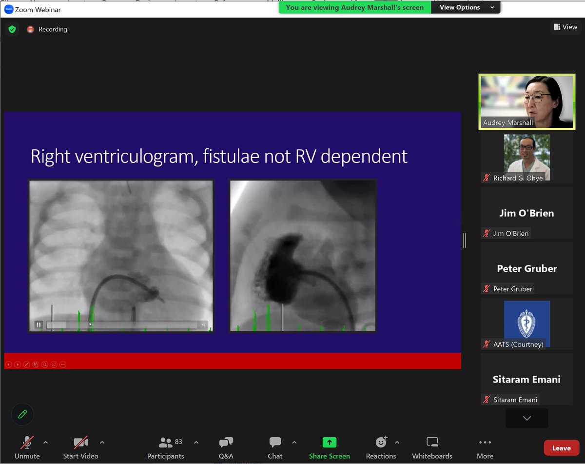 Richard G. Ohye, M.D (@rickohyemd) on Twitter photo Co-moderating a great <a href="/AATSHQ/">AATS</a> webinar with <a href="/PeterJGruber/">Peter Gruber</a> on PA/IVS and expert panelists Audrey Marshall (<a href="/SickKids/">SickKids Foundation</a>), Jim O'Brien (<a href="/ChildrensMercy/">Children's Mercy</a>), Ram Emani (<a href="/BostonChildrens/">Boston Children's</a>) and <a href="/DavidKalfaMD/">David Kalfa</a> (@KidAtColumbia). So much great information from these great minds! Co-moderating a great <a href="/AATSHQ/">AATS</a> webinar with <a href="/PeterJGruber/">Peter Gruber</a> on PA/IVS and expert panelists Audrey Marshall (<a href="/SickKids/">SickKids Foundation</a>), Jim O'Brien (<a href="/ChildrensMercy/">Children's Mercy</a>), Ram Emani (<a href="/BostonChildrens/">Boston Children's</a>) and <a href="/DavidKalfaMD/">David Kalfa</a> (@KidAtColumbia). So much great information from these great minds!
