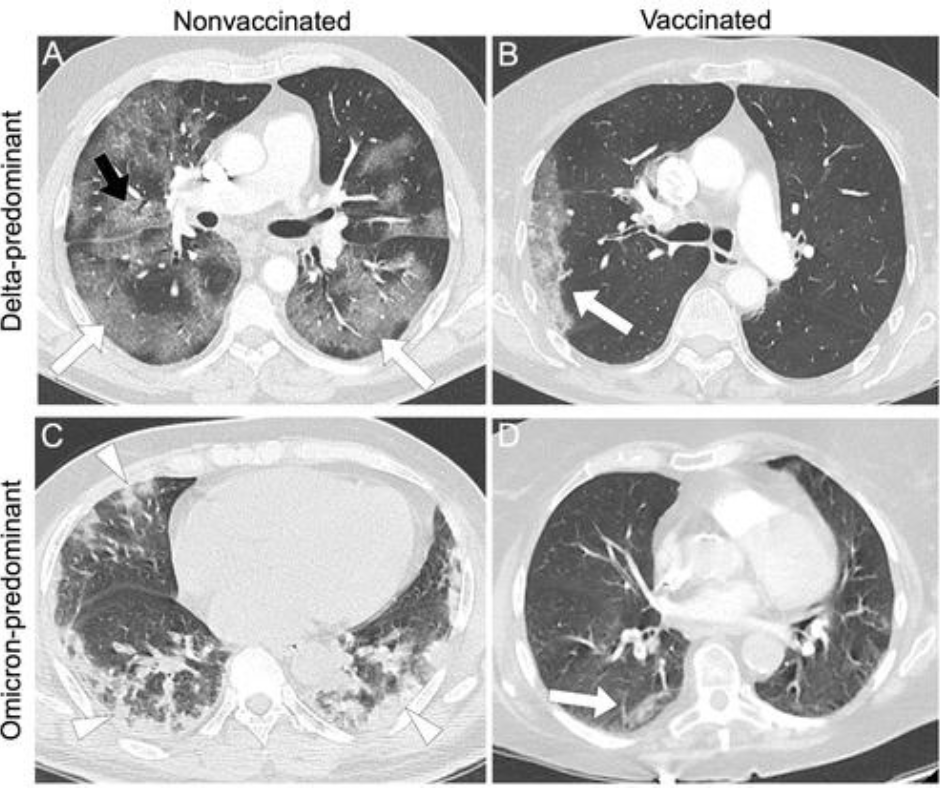 New Chest CT Study Assesses Impact of #COVID19 Variants and Vaccination Status ow.ly/4ffg50NcAG4 @gorincour @ACRRFS @ACRYPS @RadiologyACR @ARRS_Radiology @RSNA @thoracicrad @PennRadiology @DukeRadiology @EmoryRadiology @UABRadiology @UMichRadiology #radiology #CTRad #RadRes