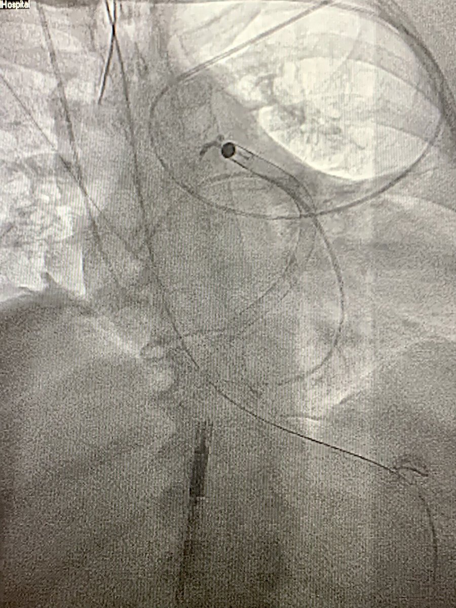 CVOMed's tweet image. #CathLabHack 🫀 Impella RP would not advance into PA on 0.027 Impella wire, but we’re successful with railing RP in over an 0.035 Amplatz Super Stiff 💪🏼 @Abiomed @BSCCardiology @SCAI #ACCFIT