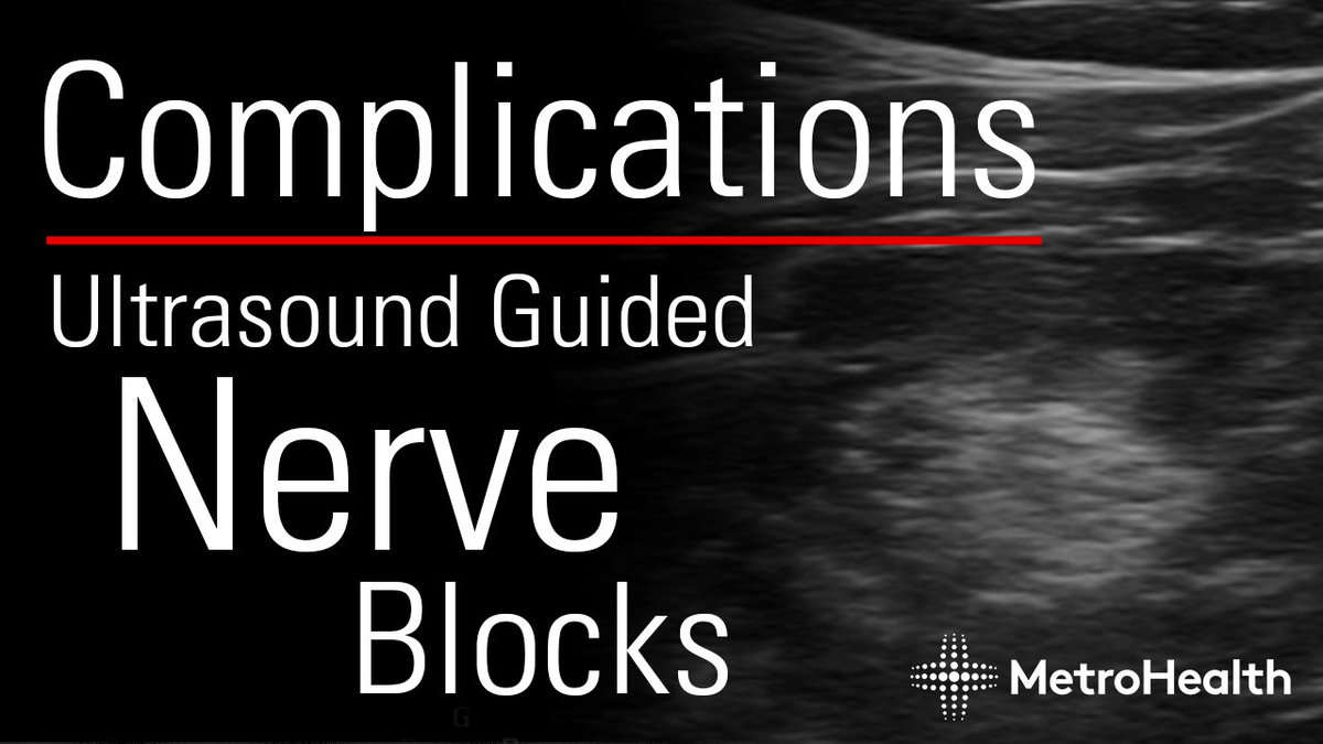 Check out the latest video from our Ultrasound Grand Rounds by @SLWerner_EM about Complications of Ultrasound Guided Nerve Blocks.

youtu.be/wVt9frJBk5s

#MetroEUS #Ultrasound #POCUS #NerveBlocks