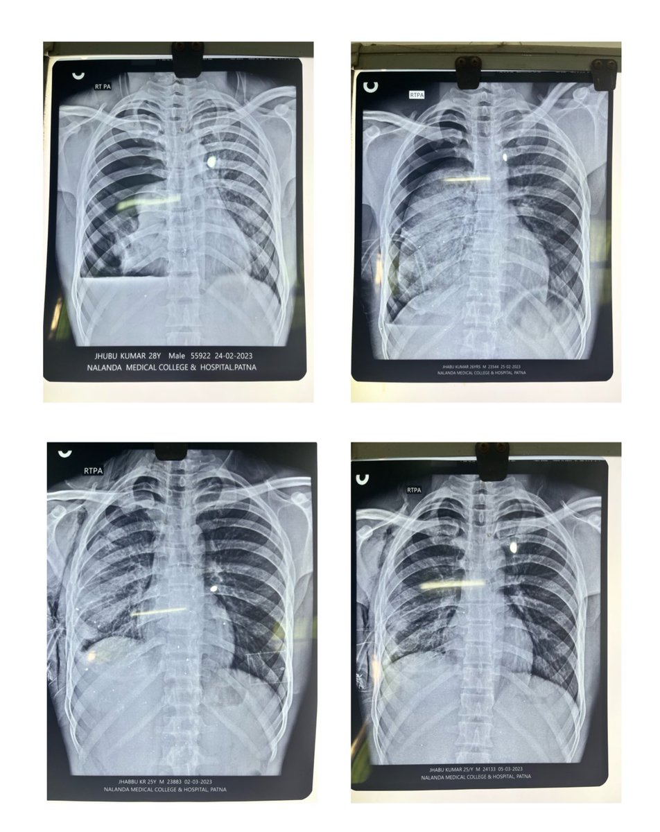 Hydropneumothorax Improvement with Chest Tube placement within 2 weeks .
#medtwitter #Medicineresidency .