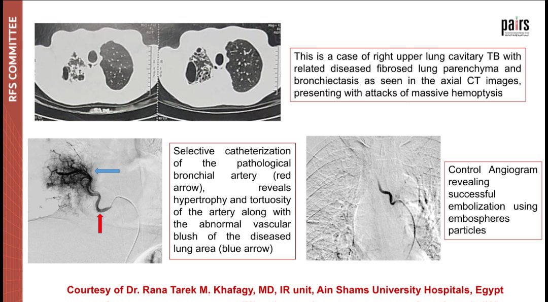 pairsmedia's tweet image. 🔔Don&apos;t miss our new RFS case series topic &quot;Bronchial Artery Embolization,&quot; prepared by Dr Ahmad Maali and Mariam Hossameldin, the main team, Egypt 
#PAIRS
#PAIRS_RFS
#WAS_ONCE_A_BEGINNER