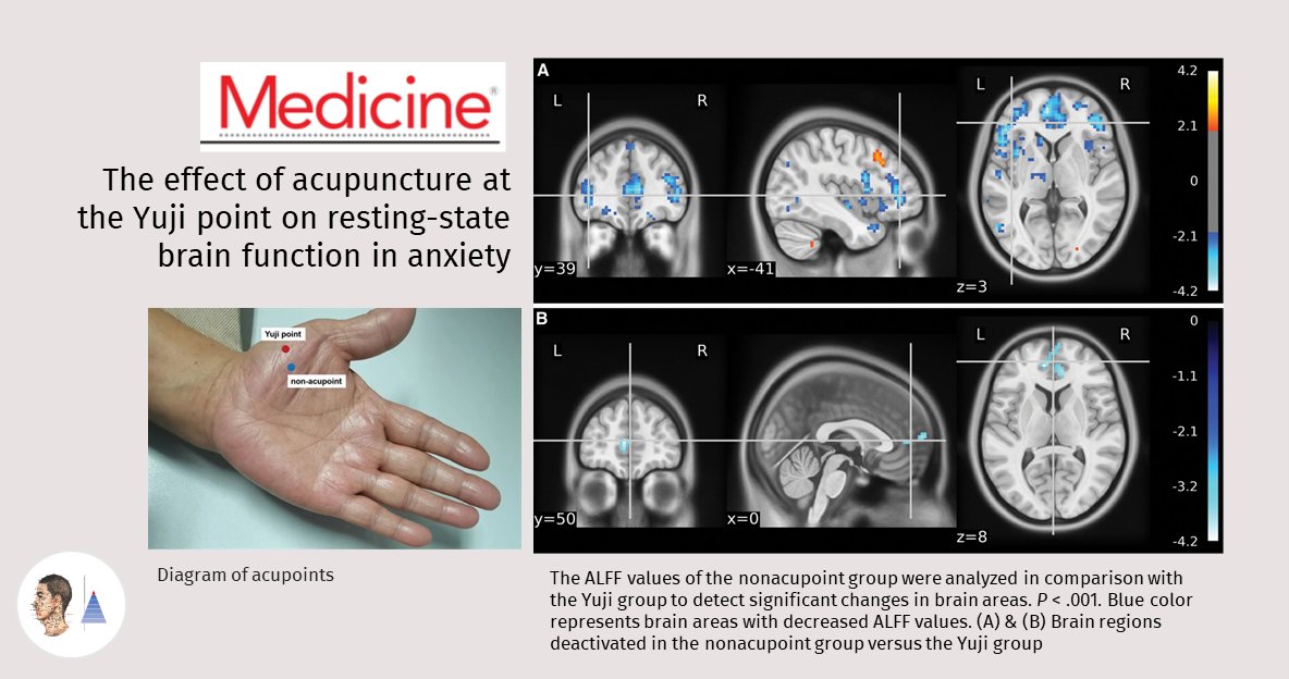 GERAacupuncture's tweet photo. ⚪Étude expérimentale 🇨🇳
📰Medicine (Baltimore) (IF 1.8)
#Anxiété. Étude de l’action différentielle de l’acupuncture [A] 𝑣𝑠 fausse [A] en IRM fonctionnelle. L’acupuncture régule l’activité cérébrale au niveau des régions impliquées par l’anxiété. 

https://t.co/RR4ApMKCIs🔓 https://t.co/7Y7rb1xC2S