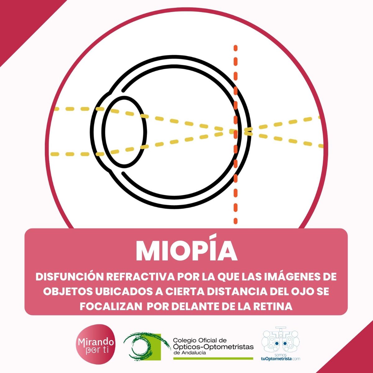 tuoptometrista's tweet photo. 🤔👓👧👦 ¿Sabrías identificar exactamente a qué defecto refractivo conocemos como miopía? 

¡Compártelo!

👉 Descubre más en: https://t.co/xPwYcyqnVS https://t.co/KyzYtYsspD