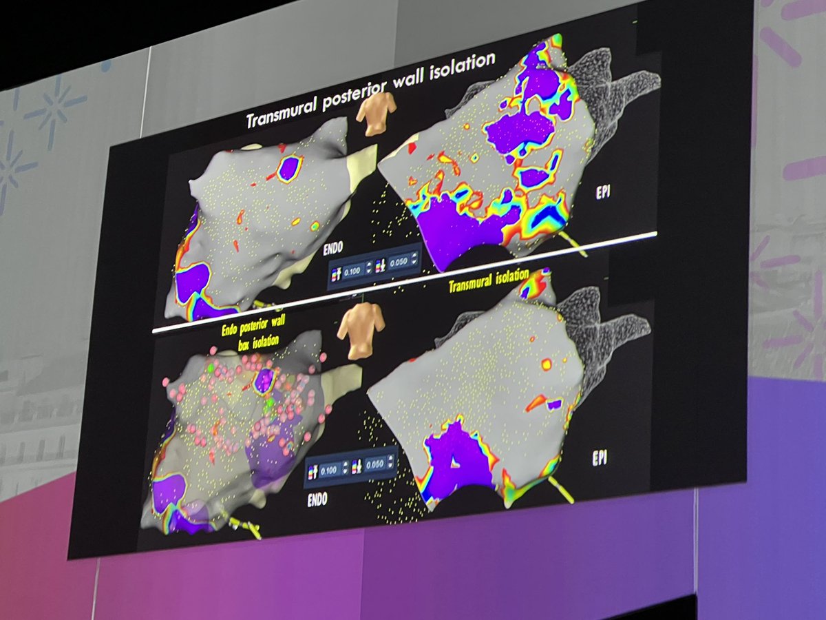 Dominik_Linz's tweet photo. #AFib2023

@DrRoderickTung is joining the conference as #halogram 😀

Wow!

A lot of #AFib procedures require epicardial ablation if posterior wall isolation is the goal.

Gaps can occur in 3- dimensions! 

@EmmaSvennberg @Phiso_de 
@DhirajGuptaBHRS https://t.co/hG3q1Snv8l