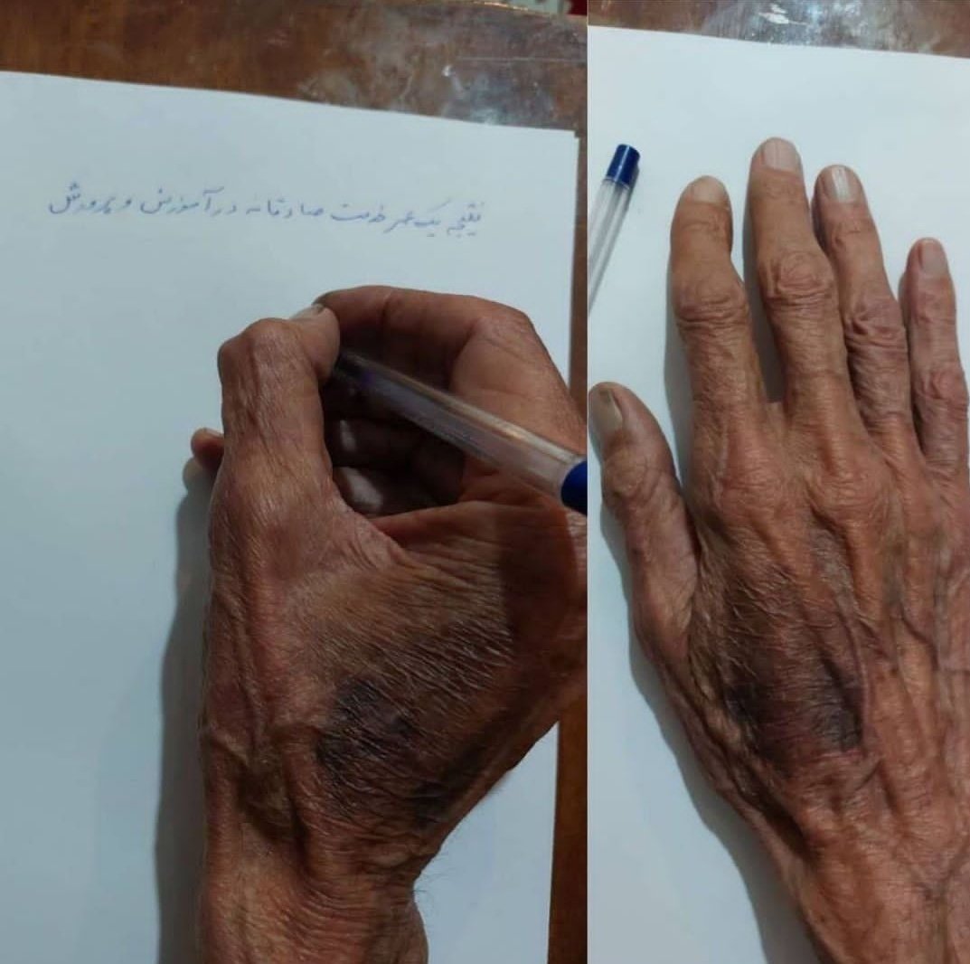 teshim11's tweet image. دستهای باتوم خورده یک معلم بازنشسته در اعتراض روز گذشته.
#مهسا_امینی