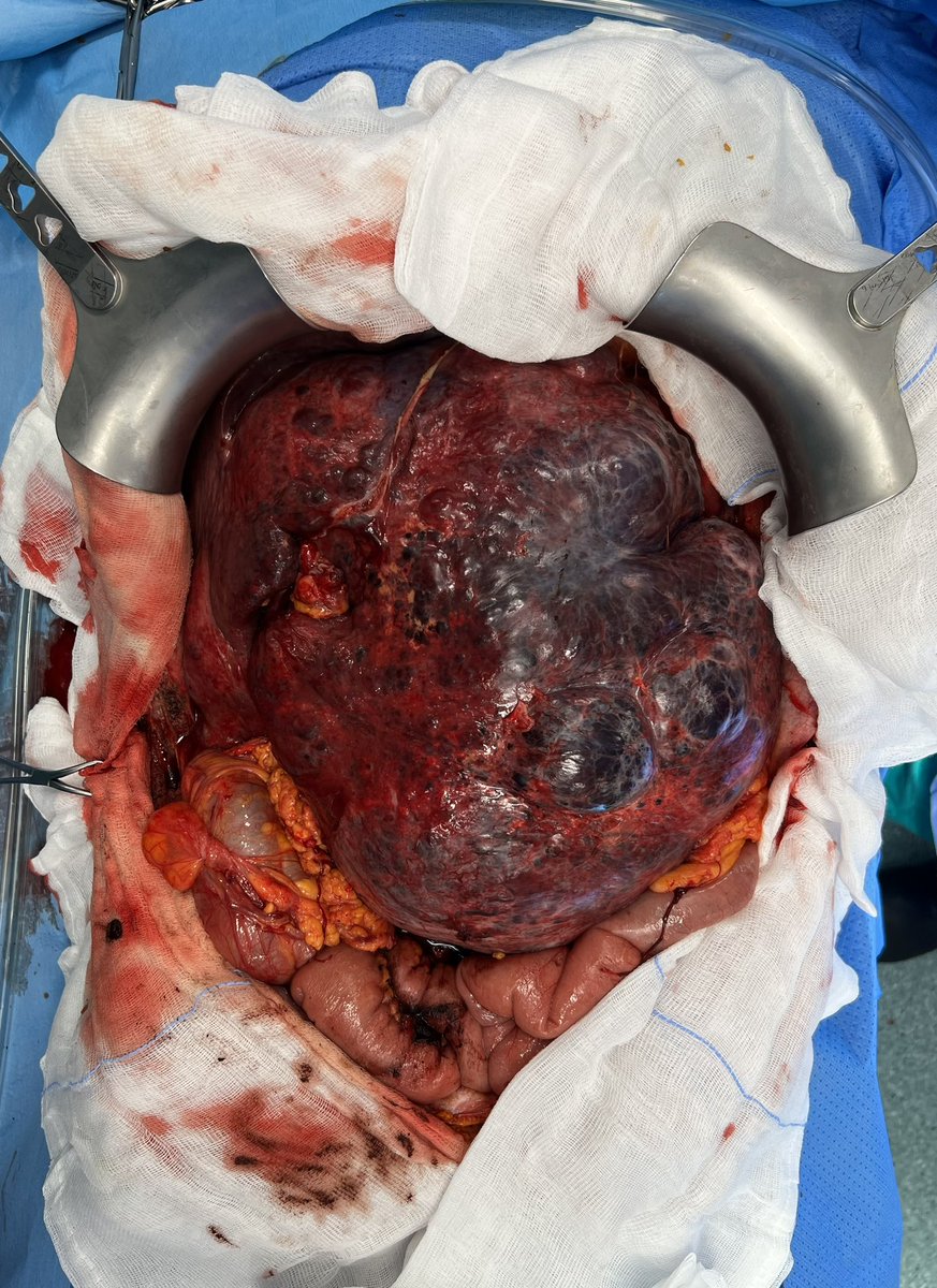 Giammatwit's tweet photo. 😱March’s challenging and rare case. Traumatic ruptured giant hemangioma successfully packed 📦 by brilliant @SimoneSan84 at OSH. Referred to us for uncontrolled growth📈@marcodoc79 @IHPBA 
@rubenciria @EAHPBA @hpb_so @hpbjournal @HpbLounge @AnnalsofSurgery @liveRPancSurg @HpbChl https://t.co/RRVPVaoSQ8
