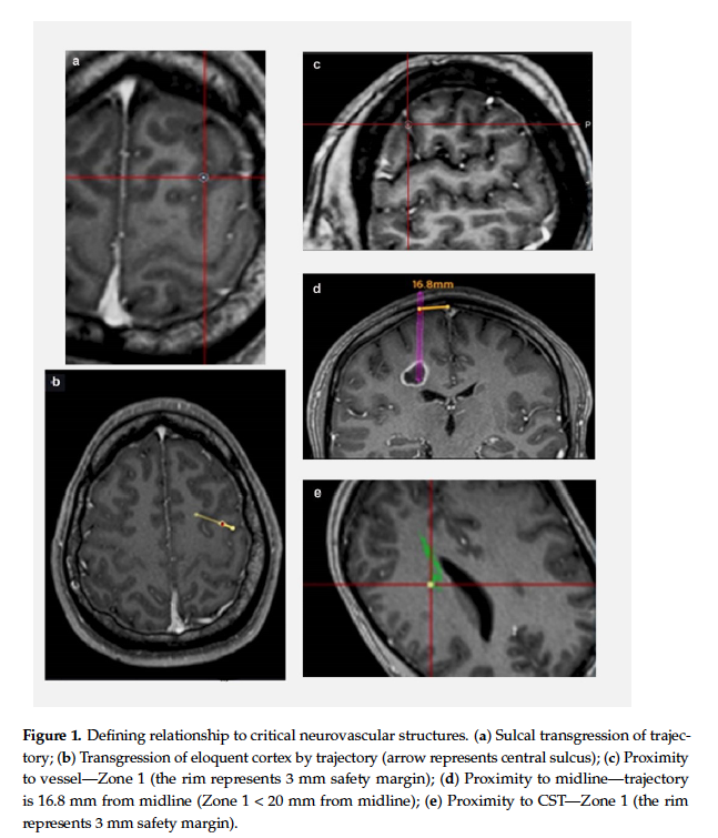KingsNeuro's tweet photo. We have now published the largest simulation study of its kind:
"Tractography-Enhanced Biopsy of Central Core Motor Eloquent Tumours: A Simulation-Based Study" in @MDPIOpenAccess.

Read more:
https://t.co/JoYzlEwRrK

💪 @lavrador_jose  @gpang93 @Sabzp87 @AhilanKVasan https://t.co/OGV7gDtXrf