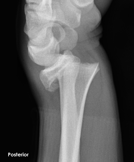 RadMasterclass's tweet photo. CLASSIC TRAUMA X-RAY 80: Child. Fall onto outstretched hand. Lateral wrist view. What is the eponymous injury? 
See answer https://t.co/g0q3ANsyrW https://t.co/XrXeUBHOQP