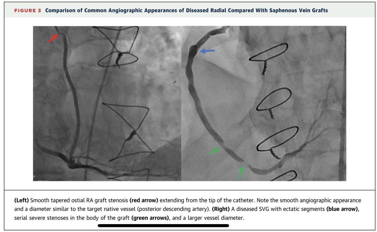 Differences in lesion characteristics between #radial and #SVG graft lesions highlight variation in #pathogenesis of graft stenosis (RA ⬆️Ostial/distal anastamosis lesions) <a href="/DrJRamchand/">Jay Ramchand MD PhD</a> <a href="/dralexcmurphy/">Alex Murphy</a> <a href="/LouiseBurrell3/">Louise Burrell MD</a> <a href="/Austin_Library/">Austin Library</a> <a href="/mmamas1973/">Mamas A. Mamas</a>