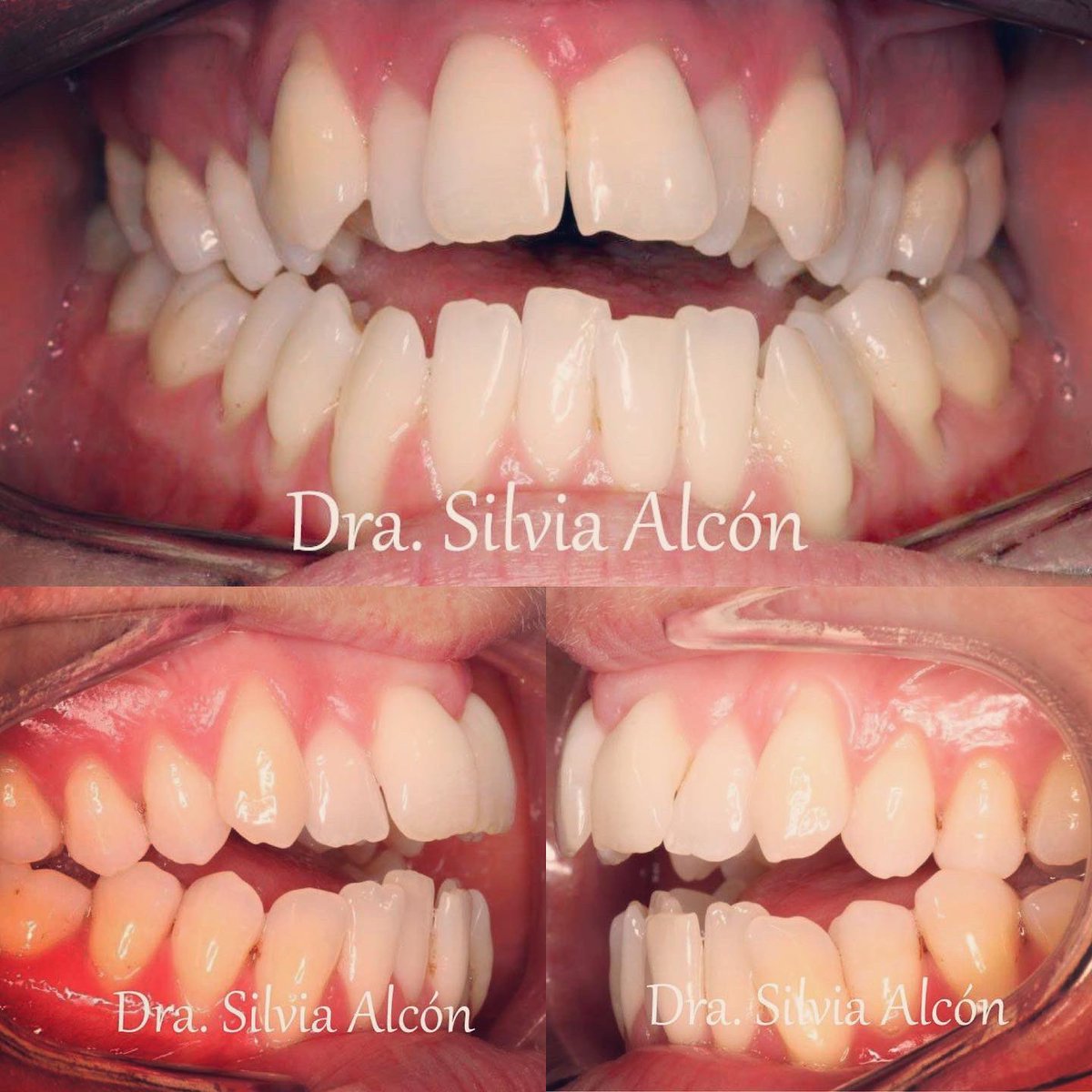 DraSilviaAlcon's tweet photo. 🦷 Tratamiento de #mordidaabierta anterior con #apiñamiento severo y #mordidacruzada bilateral esquelética sin #cirugía con el sistema #Insignia.
#Ortodoncista #DraSilviaAlcón #DentistaGetafe #Salcodent #ClínicaDentalSalcodent #OrtodoncistaGetafe #DentistaGetafe https://t.co/9R9vlz0BgZ