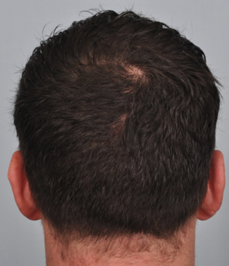 Case report: alopecia areata treated with the JAK1 inhibitor trial agent filgotinib

Read more: doi.org/10.1093/bjd/lj…