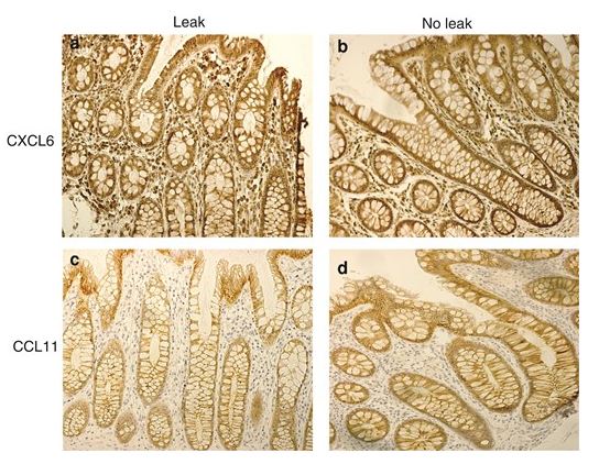 BjsOpen's tweet image. Read this Editorial written by two Editors, 
@LauraLorenzonMD and @Mcfark, on #colorectalcancer research published recently. #ECCAM2023 #StepUp4CRC #ColorectalCancerAwarenessMonth 

tinyurl.com/mry28je7
