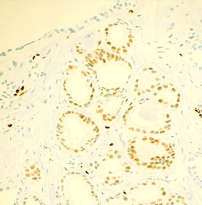 DrAlessandroIac's tweet photo. Prostatic carcinoma, acinar variant sec. WHO.

#urology #uropath #uropathology #uropatologia #prostatecancer #prostate #prostata #malecancer #oncology #oncologia #onco #medlife #pathlife #pathology #pathologist #webpath #digitalpathology #cardarelli #anatomiapatologica https://t.co/VGwv39FnRU