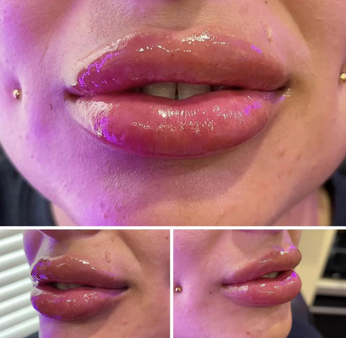 Allure Aesthetix 
361-462-4464 
Allergan’s TOP 5 Injector 

May use Alle points & coupons #lips #lipfiller #lipinjections #cosmeticiniector #beauty 
#botox #masterinjector #allergan #cosmetic #injectables #beauty #corpuschristi #women #juvederm
