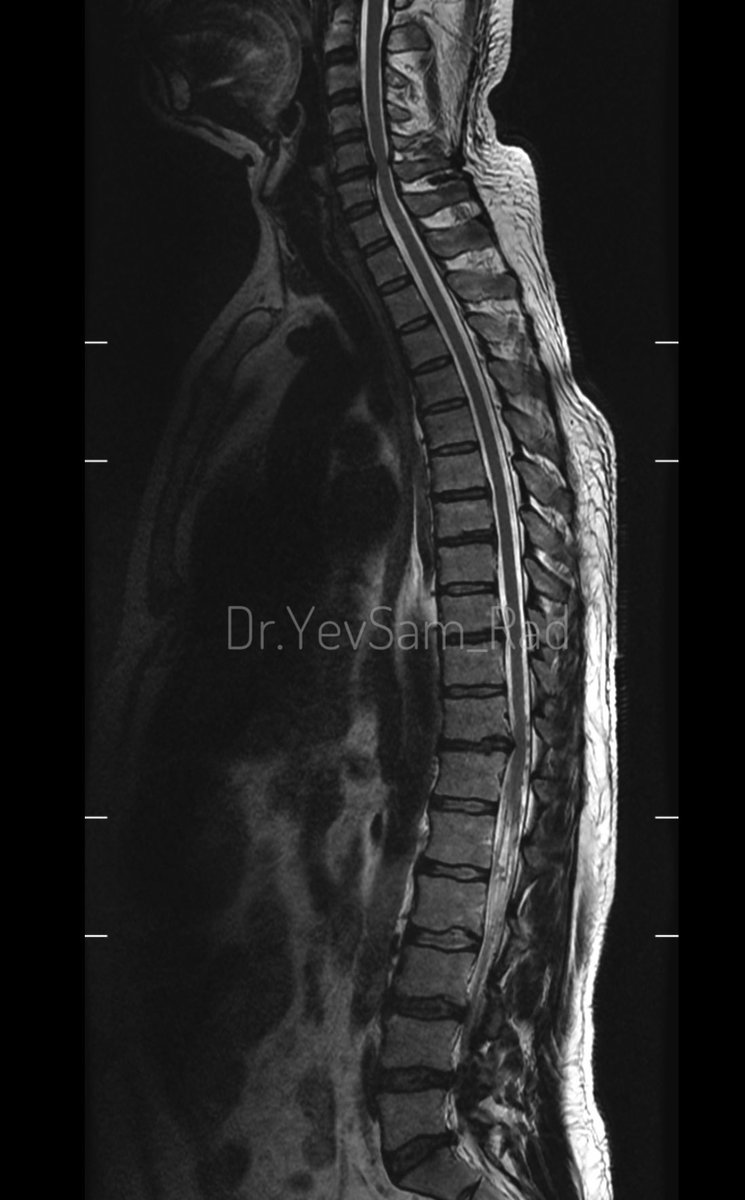 DrYevSam_Rad's tweet image. Young gentleman came with severe low back ache following an episode of dengue fever. What do we see here?

#spineimaging
#medtwitter
#radtwitter 
#FOAMrad 
#neuroimaging 

@drvenkimdrd