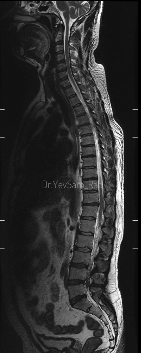 DrYevSam_Rad's tweet image. Young gentleman came with severe low back ache following an episode of dengue fever. What do we see here?

#spineimaging
#medtwitter
#radtwitter 
#FOAMrad 
#neuroimaging 

@drvenkimdrd