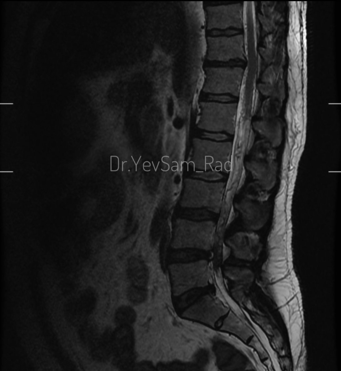 DrYevSam_Rad's tweet image. Young gentleman came with severe low back ache following an episode of dengue fever. What do we see here?

#spineimaging
#medtwitter
#radtwitter 
#FOAMrad 
#neuroimaging 

@drvenkimdrd