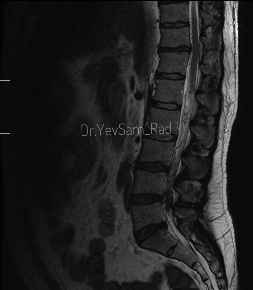 DrYevSam_Rad's tweet image. Young gentleman came with severe low back ache following an episode of dengue fever. What do we see here?

#spineimaging
#medtwitter
#radtwitter 
#FOAMrad 
#neuroimaging 

@drvenkimdrd