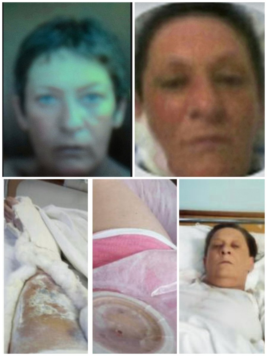 RadaSimi3's tweet photo. 2007, posle 1 hemioterapije, 2008 posle 1 operacije, 2019 prelom noge, 2020 tezak mozdani udar gde mi je oduzeta desna strana lica, ruke i noge a govor mi se vratio nije bas dobro ali mi se vratio, pisem Vam ovo da bi bolje shatili.. Zato Vas molim za 1 poruku 1016 na 3030 https://t.co/1tkARUytYw