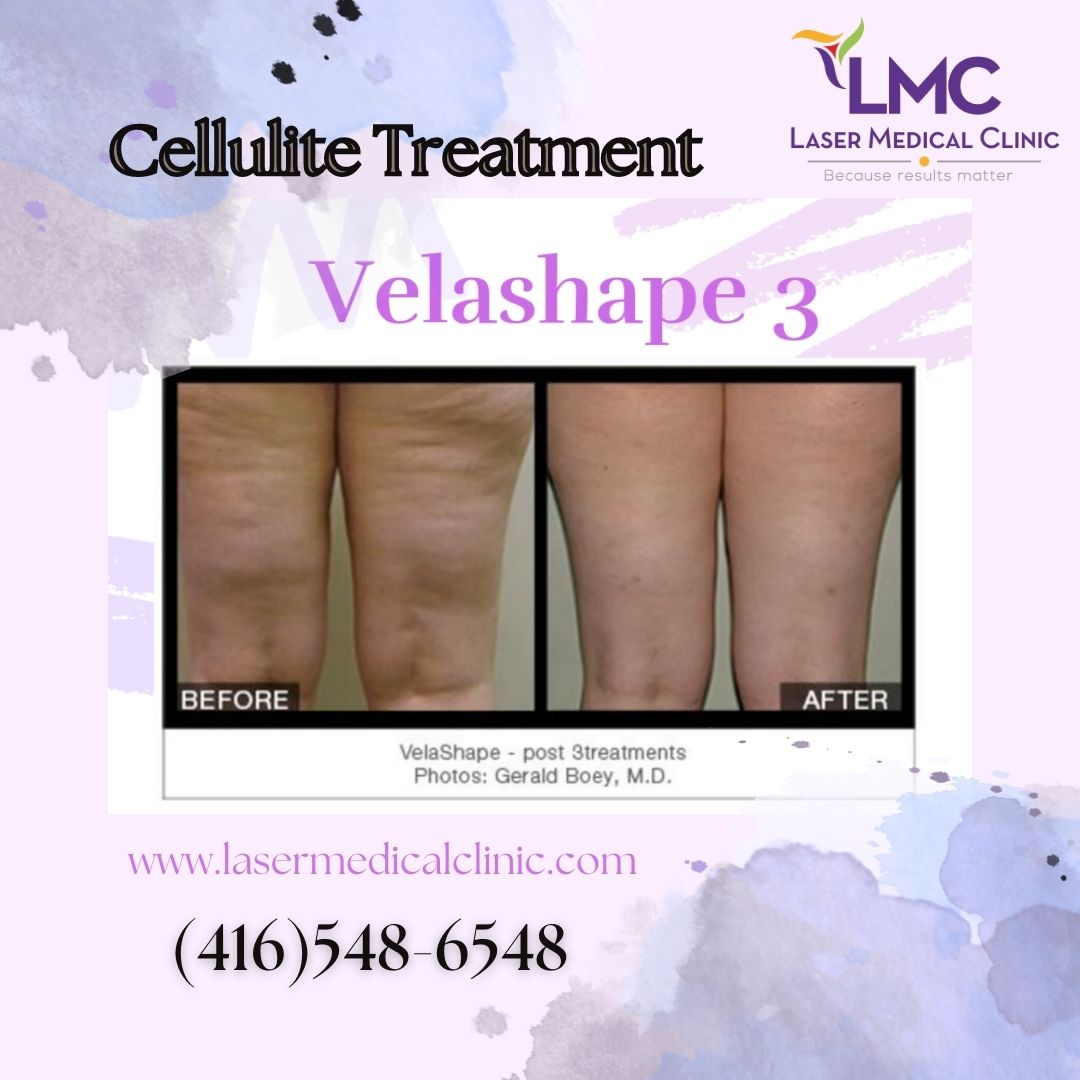 Do you want to get rid of your #cellulite, get a #ButtLift, and tighten your #skin? You can do all of that with our #VelashapeIIITechnology!

🌎 Learn More: lasermedicalclinic.com/velashapeiii/

#CelluliteReduction #CelluliteTreatment #ButtockLift #SkinTightening #VelaShape #FatReduction #LMC