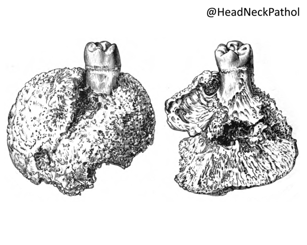 The True History of Cementoblastoma
Fumio Ide, Shinnichi Sakamoto, Yuji Miyazaki, Miyako Hoshino, Michiko Nishimura, Takashi Muramatsu &amp; Kentaro Kikuchi
rdcu.be/c7fbD
#HeadNeckPathol #HNPJ #HeadandNeckPath #Pathology #ENTPath #PathologyTweet