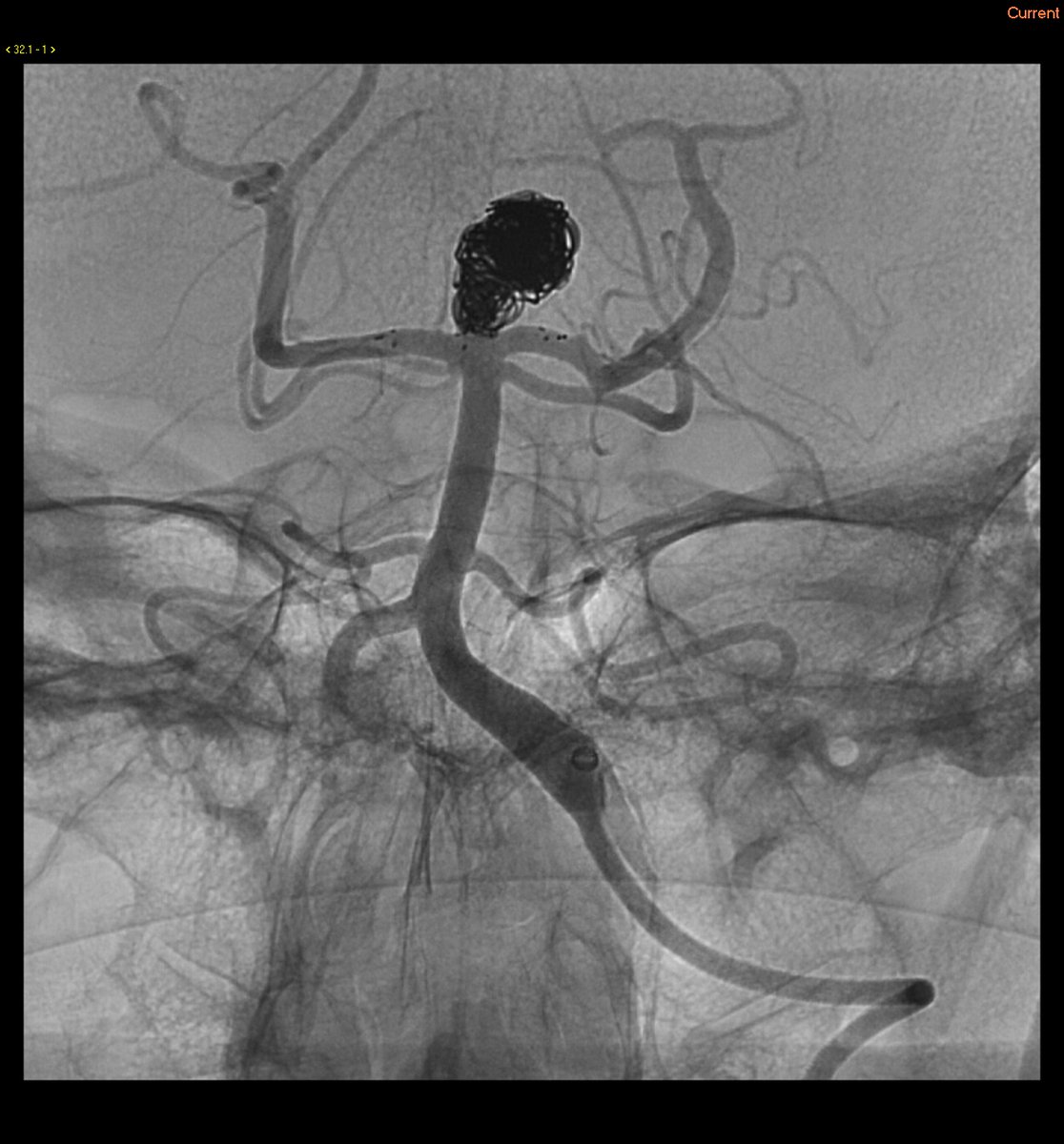 Neurovascular Center @ St. Michael's Hospital (@smhneurovasc) on Twitter photo Check it out! <a href="/trmarot/">Tom Marotta</a> @VitorMendesPer1 <a href="/DanniDiestro/">Dr. DiestroKE</a> Pre and post-treatment catheter angiograms (with permission) Check it out! <a href="/trmarot/">Tom Marotta</a> @VitorMendesPer1 <a href="/DanniDiestro/">Dr. DiestroKE</a> Pre and post-treatment catheter angiograms (with permission)