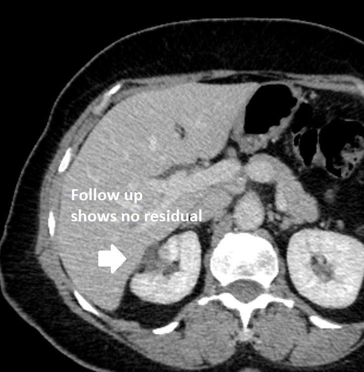 Kidney #cancer located superiorly treated by interventional radiology (#IRad) with a transhepatic approach. The follow up CT shows no evidence of residual disease. You can check out our multi-center experience with this approach in @JVIRmedia here: bit.ly/3Zw6uJw