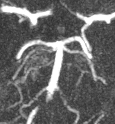 Neurovascular Center @ St. Michael's Hospital (@smhneurovasc) on Twitter photo Optical coherence tomography (OCT) images by <a href="/gentuity/">Gentuity</a> coming soon. <a href="/RADIS_lab/">RADIS lab</a> <a href="/NMCancelliere/">Nicole Cancelliere</a> For now, here are the pre and post-treatment MRI images (with permission) showing aneurysm obliteration with <a href="/evasc/">evasc</a> eCLIPS and coils. Pretty cool 😎 <a href="/CarmenPFarinas/">Carmen Parra-Fariñas</a> Optical coherence tomography (OCT) images by <a href="/gentuity/">Gentuity</a> coming soon. <a href="/RADIS_lab/">RADIS lab</a> <a href="/NMCancelliere/">Nicole Cancelliere</a> For now, here are the pre and post-treatment MRI images (with permission) showing aneurysm obliteration with <a href="/evasc/">evasc</a> eCLIPS and coils. Pretty cool 😎 <a href="/CarmenPFarinas/">Carmen Parra-Fariñas</a>