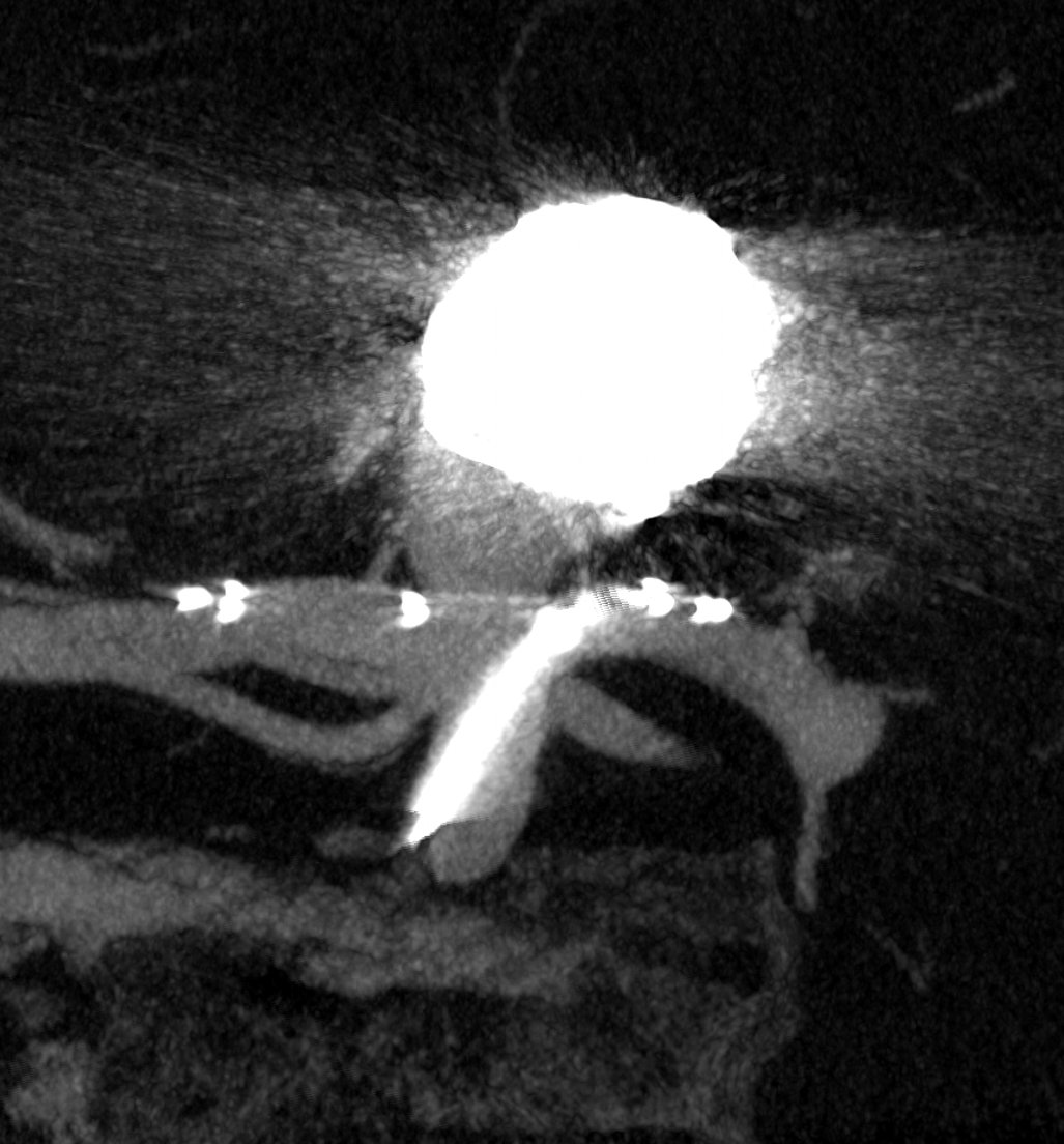 Neurovascular Center @ St. Michael's Hospital (@smhneurovasc) on Twitter photo Vaso CT (w/ permission) <a href="/PhilipsHealth/">Philips Healthcare</a> shows beautiful neck bridging by the <a href="/EvascMed/">Evasc Neurovascular</a> eCLIPs prior to re-coiling. Cutting-edge endovascular therapy 🤓😎 everyday <a href="/SmhNeuroVasc/">Neurovascular Center @ St. Michael's Hospital</a> <a href="/UnityHealthTO/">Unity Health Toronto</a> <a href="/trmarot/">Tom Marotta</a> @VitorMendesPer1 <a href="/DanniDiestro/">Dr. DiestroKE</a> <a href="/UofTNeuroSurge/">University of Toronto Neurosurgery</a> <a href="/UofTNeurology/">UToronto Neurology</a> <a href="/UofTMedIm/">UofT Medical Imaging</a> Vaso CT (w/ permission) <a href="/PhilipsHealth/">Philips Healthcare</a> shows beautiful neck bridging by the <a href="/EvascMed/">Evasc Neurovascular</a> eCLIPs prior to re-coiling. Cutting-edge endovascular therapy 🤓😎 everyday <a href="/SmhNeuroVasc/">Neurovascular Center @ St. Michael's Hospital</a> <a href="/UnityHealthTO/">Unity Health Toronto</a> <a href="/trmarot/">Tom Marotta</a> @VitorMendesPer1 <a href="/DanniDiestro/">Dr. DiestroKE</a> <a href="/UofTNeuroSurge/">University of Toronto Neurosurgery</a> <a href="/UofTNeurology/">UToronto Neurology</a> <a href="/UofTMedIm/">UofT Medical Imaging</a>