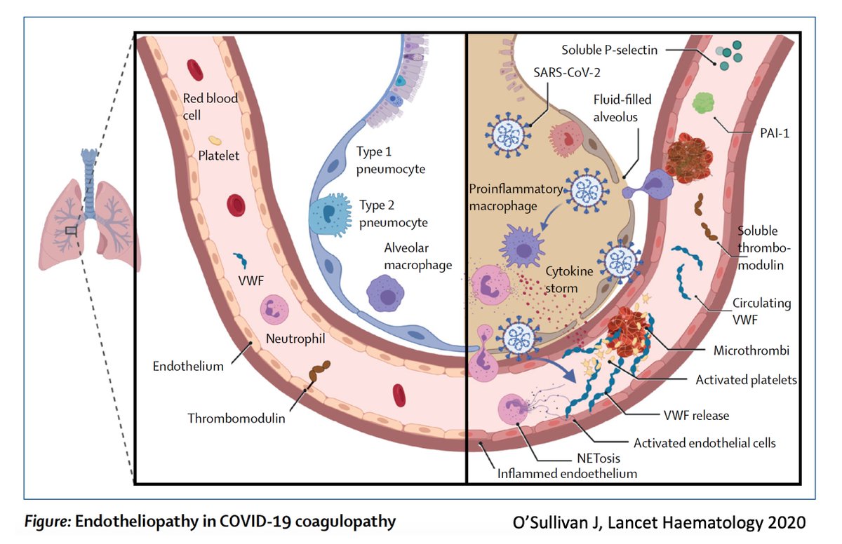 EricTopol's tweet image. Beyond a month post-Covid, there&apos;s a significantly elevated risk of clots, including heart attacks and strokes that has been established by multiple studies, with reduced risk among those vaccinated
erictopol.substack.com/p/heart-attack…