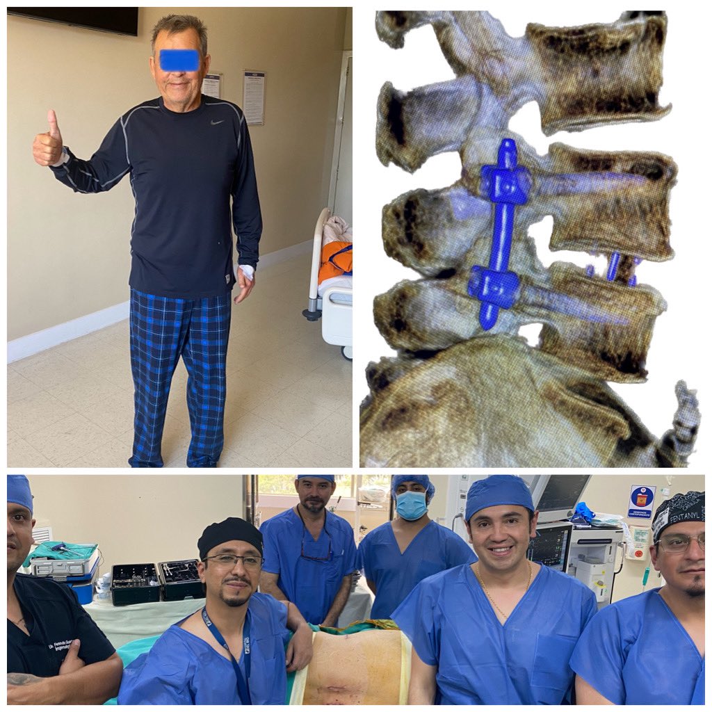 pterion77's tweet photo. Pte 72a, diabético , con lumbociatica,discopatia L3-L4, realizamos un DLIF más tornillos,utilizando el principio de “SINGLE POSITION SURGERY”alta al siguiente día con mejoría de sus síntomas, @pablopenatapia @HospitaldelRio @Invimedic #singlepositionlateral #singlepositionsurgery https://t.co/aROwWTEGkc