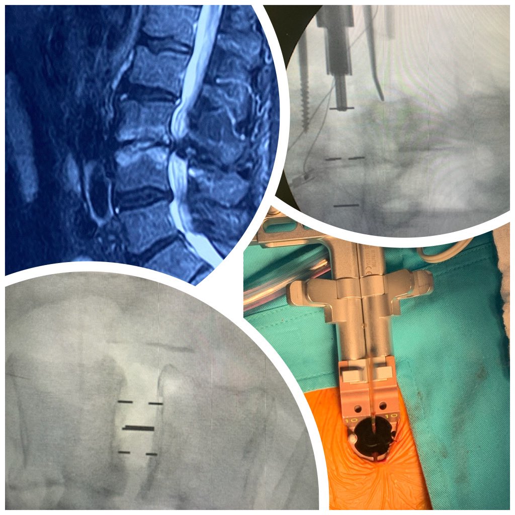 pterion77's tweet photo. Pte 72a, diabético , con lumbociatica,discopatia L3-L4, realizamos un DLIF más tornillos,utilizando el principio de “SINGLE POSITION SURGERY”alta al siguiente día con mejoría de sus síntomas, @pablopenatapia @HospitaldelRio @Invimedic #singlepositionlateral #singlepositionsurgery https://t.co/aROwWTEGkc