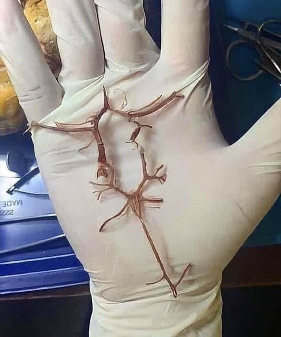 BrownJHM's tweet photo. Circle of Willis (ofdukeneurosurg) #Medtwitter https://t.co/wLlYjHFcB7