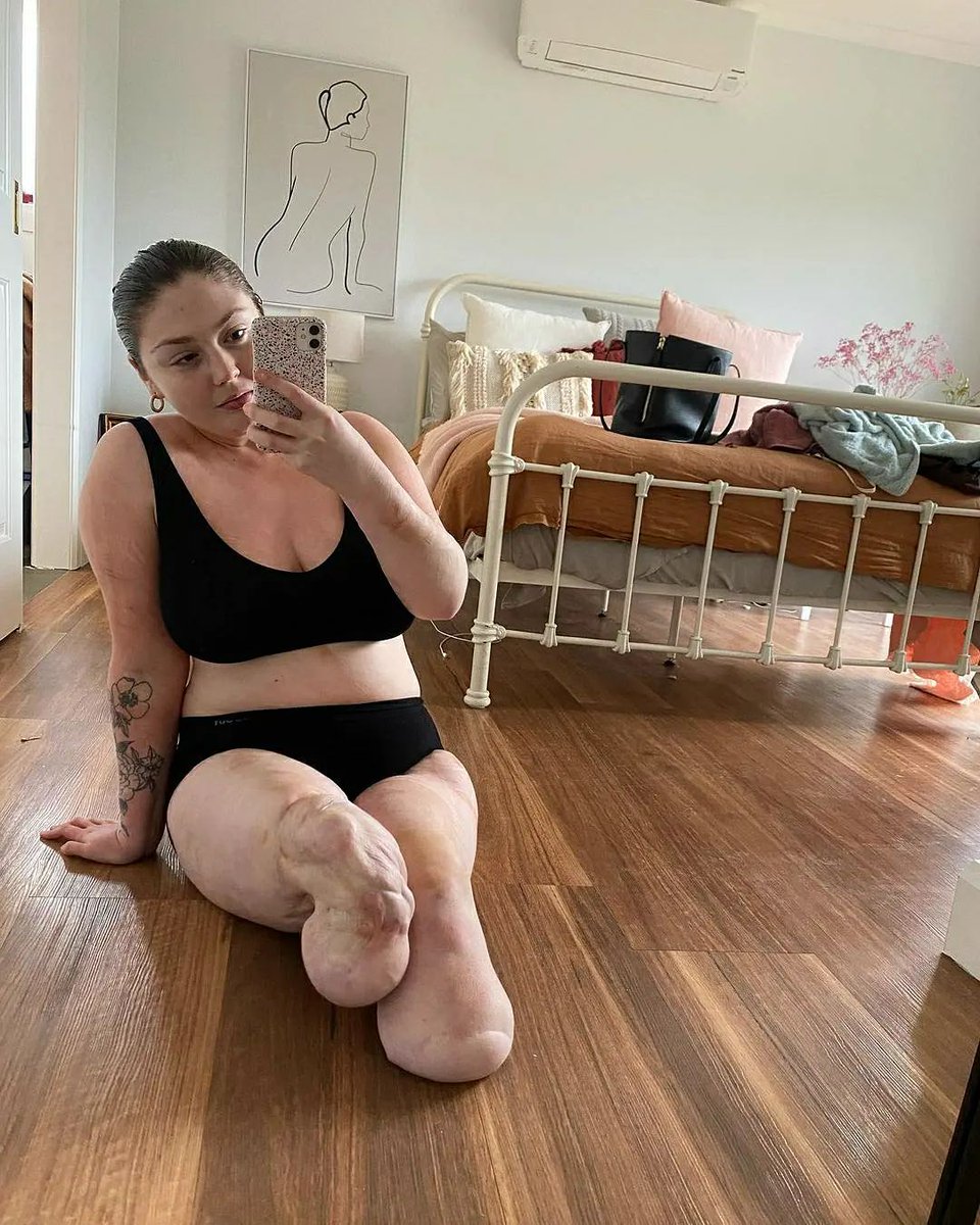 Dating4D's tweet photo. ๐ฆฟsome pure beauty ๐ by Lauren โฟ
#disabledhighlight
๐ธ: @lauren_mcdonough
.
Click in the link below for more information!
https://t.co/r8pWCoBRZY
.
#dating4disabled #disabledandcute #disabledandbeautiful #disability #disabled #disabledfashioninfluencer #disableddating https://t.co/cjgJg3rlCc