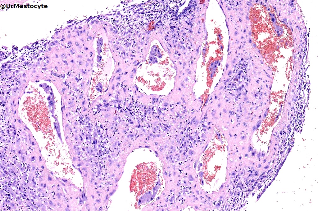 Decidua with trophoblastic vascular pseudoinvasion #GYNpath #Pathology