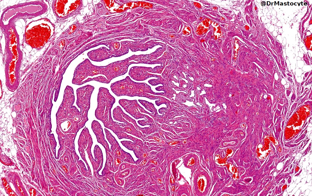 DrMastocyte's tweet image. Minimal adenomatoid tumor #GYNpath #Pathology  fallopian tube