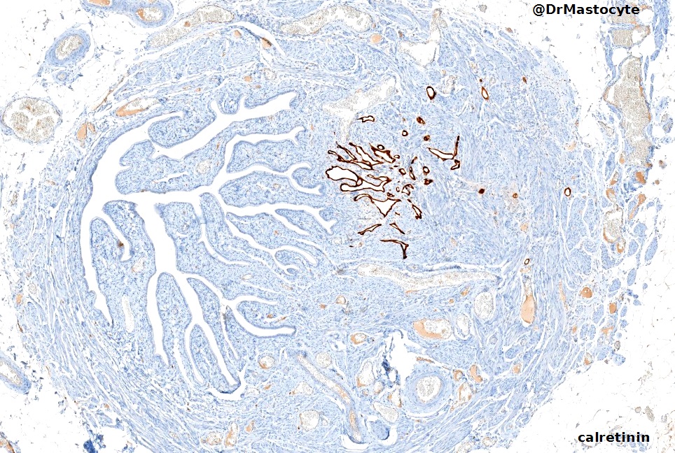 DrMastocyte's tweet image. Minimal adenomatoid tumor #GYNpath #Pathology  fallopian tube