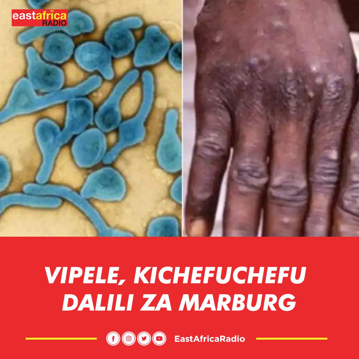 earadiofm's tweet photo. #NUKUU "Dalili nyingine ni vipele vidogo vidogo kwenye kifua, sehemu ya mgogo  na tumboni, kusikia kichefu chefu kutapika, koo kuwasha, kuharisha , kupungua uzito kwa haraka sana na wengine huonesha kama kuchanganyikiwa" - Dr Rashid Mfaume, RMO Dar es salaam. https://t.co/OLOikBM6vQ