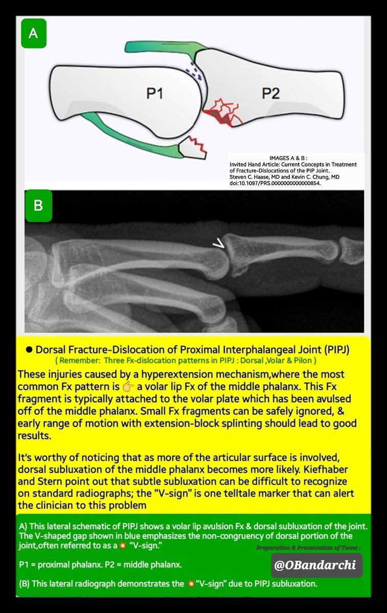 Proximal interphalangeal (PIP) joint is the most common injured joint in hand.

💥3 Fx-dislocation patterns recognized : Dorsal,Volar &amp; Pilon. This tweet addressed dorsal type.

Pilon type involving both volar &amp; dorsal cortical margins of middle phalangeal base.(see the comment )