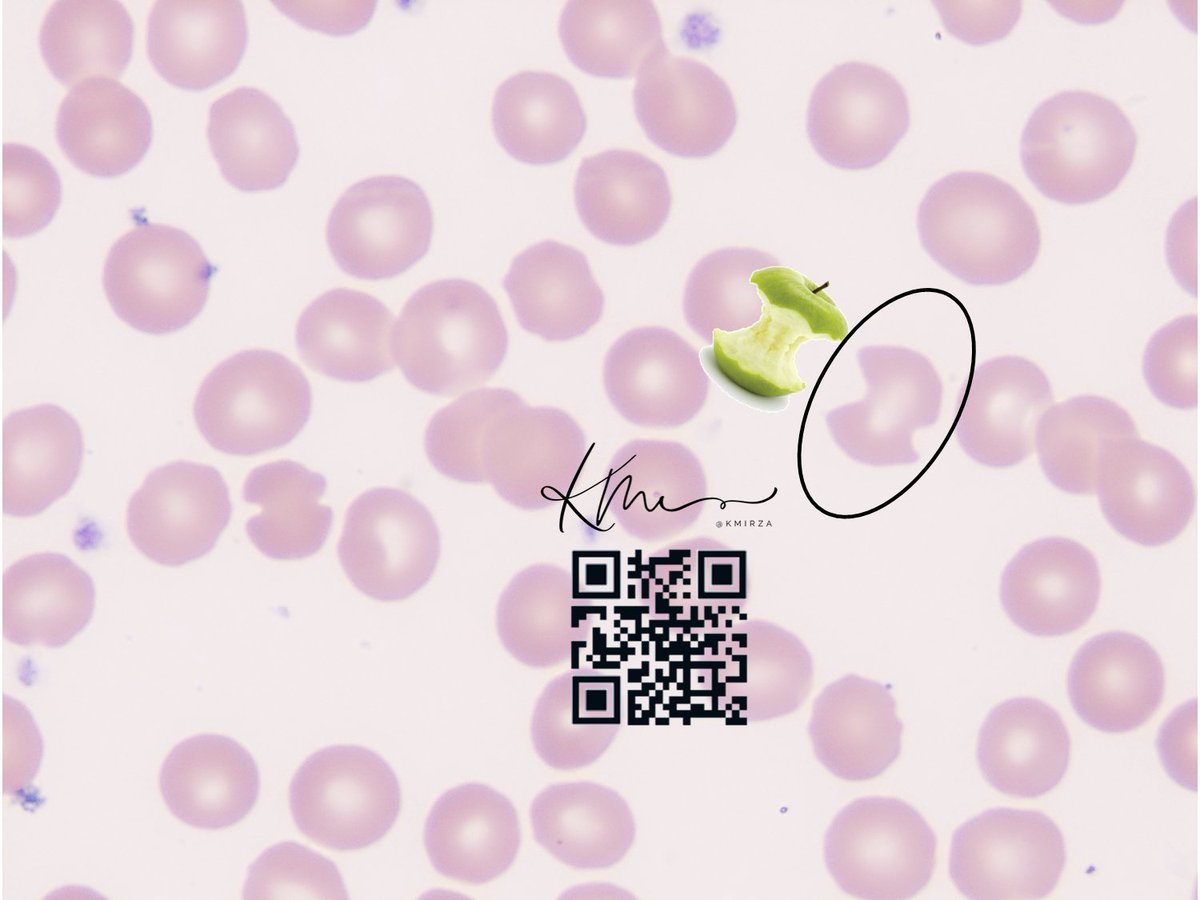 KMirza's tweet photo. Cool images by @AaronGoodman33 - piggybacking off image of Heinz body (supravital stain in original tweet)

When the spleen interrogates cells with Heinz bodies it will 'bite' out a piece of the cell, leaving blister/bite/apple core cells (shown here)

#hemepath #hematology https://t.co/RFEDqpM20x