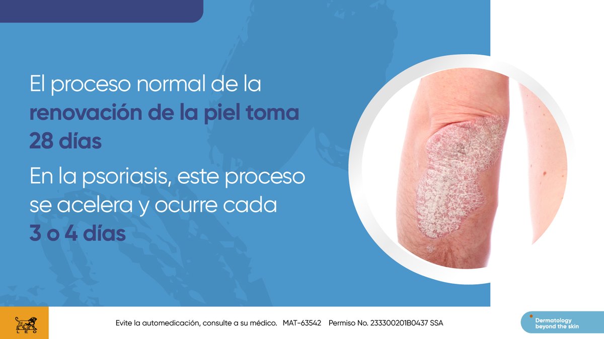 LeoPharmaMX's tweet photo. La psoriasis es una enfermedad de la piel que a veces se confunde con otras, lo que retrasa su diagnóstico y el tratamiento que la puede controlar.
#psoriasis #LEOPharmaMx #LEOPharma #LeoTips https://t.co/e386bMFJwa