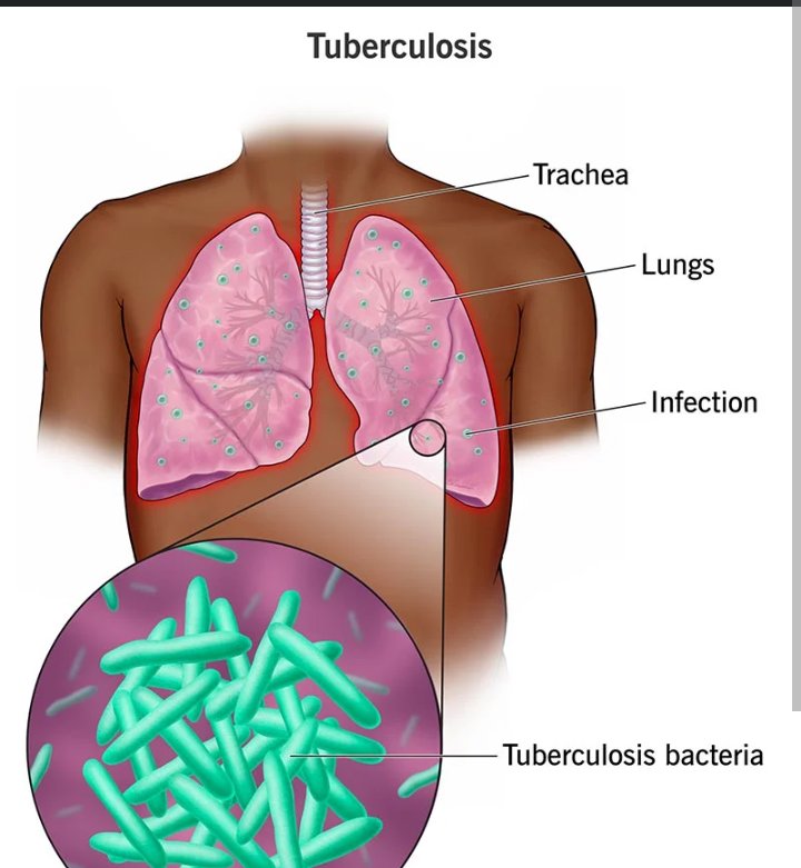 MoyoPanash's tweet photo. As we commemorate the international TB day 24/03/23, let's join force in ending the Tuberculosis stigmatization.

TB is a potentially serious infectious bacterial disease that mainly affects the lungs.
@investtoendtb
#yeswecanendtb
@SAYWHATOrg https://t.co/FEzjcaqV5p