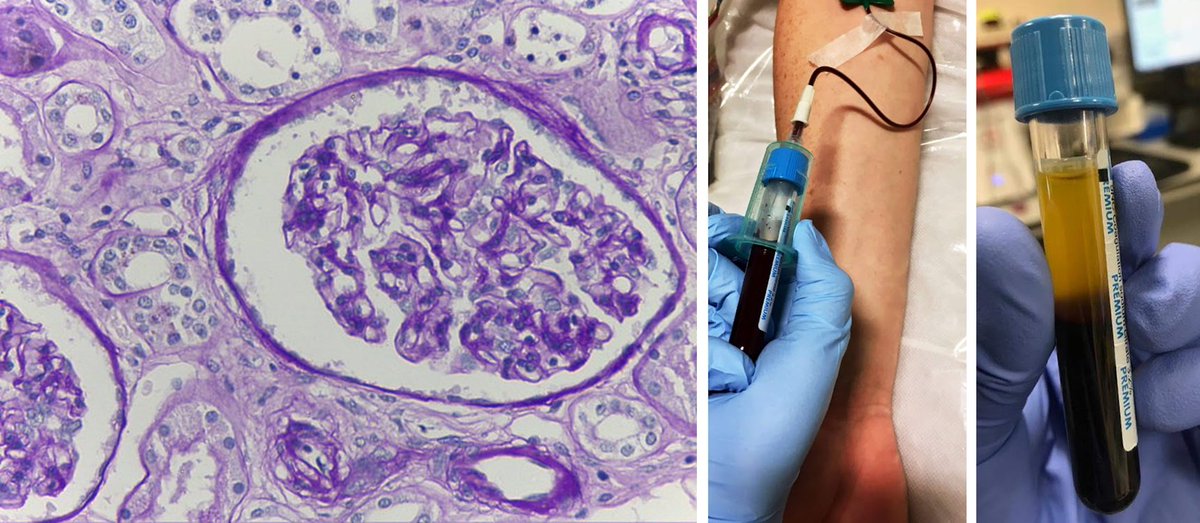 MMU Thrombosis Research Group (@mmu_thrombosis) on Twitter photo 📢PhD Opportunity!📢
👩🔬Looking for a PhD with a clinical/patient focus?👩🔬
Join <a href="/Drsjones1982/">Sarah Jones</a> @AmandaUnsworth1 <a href="/NEHadgraft/">Dr Natasha Hadgraft</a> & <a href="/MMU_thrombosis/">MMU Thrombosis Research Group</a> to investigate the use of haemostatic markers as prognostic tools in chronic kidney disease 🩸🔬
ℹ️ Info at: bit.ly/3yURk51 📢PhD Opportunity!📢
👩🔬Looking for a PhD with a clinical/patient focus?👩🔬
Join <a href="/Drsjones1982/">Sarah Jones</a> @AmandaUnsworth1 <a href="/NEHadgraft/">Dr Natasha Hadgraft</a> & <a href="/MMU_thrombosis/">MMU Thrombosis Research Group</a> to investigate the use of haemostatic markers as prognostic tools in chronic kidney disease 🩸🔬
ℹ️ Info at: bit.ly/3yURk51