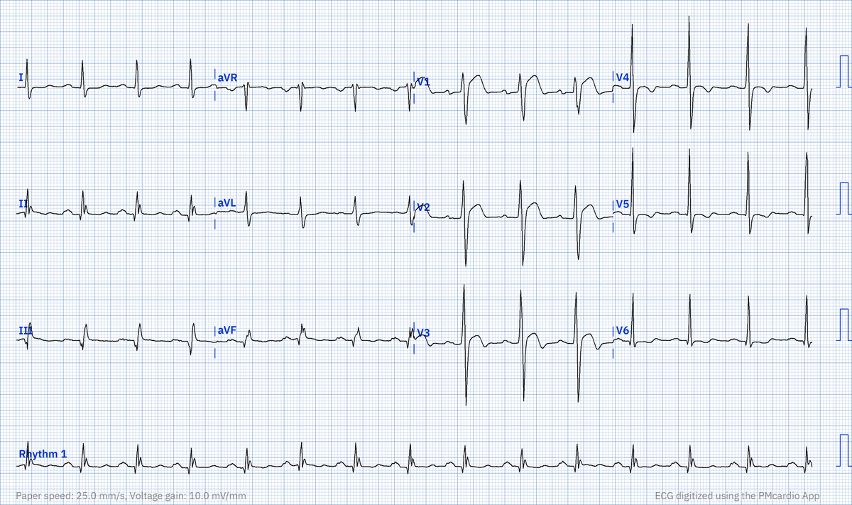 RobertHermanMD's tweet photo. @richardbogle Here is the digitized ECG. https://t.co/5Xl2FI5Aah